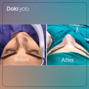 مقایسه قبل و بعد از عمل بینی توسط دکتر آرزو کازرونی