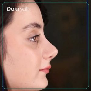 جراحی بینی بت دکتر جواد خالقی در تهران