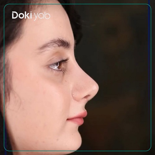 نمونه عمل بینی با دکتر جواد خالقی جراح بینی تهران