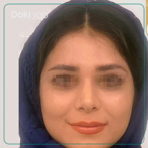 نمونه جراحی بینی دکتر مجید راستی در اصفهان