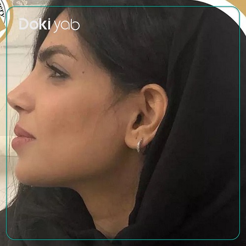 نمونه جراحی بینی دکتر مجید راستی در اصفهان