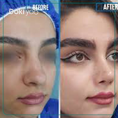 عمل بینی با دکتر حبیب سهرابی جراح بینی در تهران