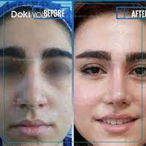نمونه عمل بینی با دکتر حبیب سهرابی جراح بینی در تهران