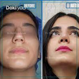 نمونه کار دکتر حبیب سهرابی جراح بینی تهران
