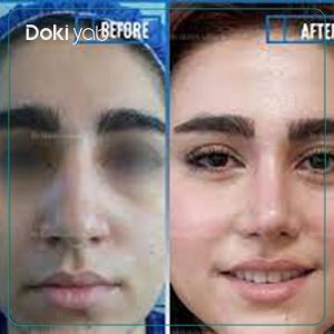نمونه عمل بینی دکتر حبیب سهرابی جراح بینی تهران