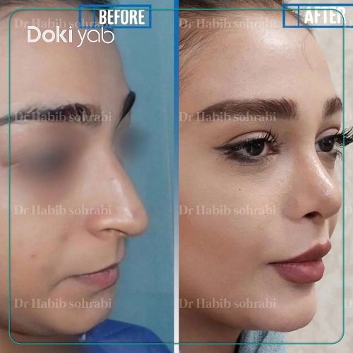 نمونه عمل بینی توسط دکتر حبیب سهرابی
