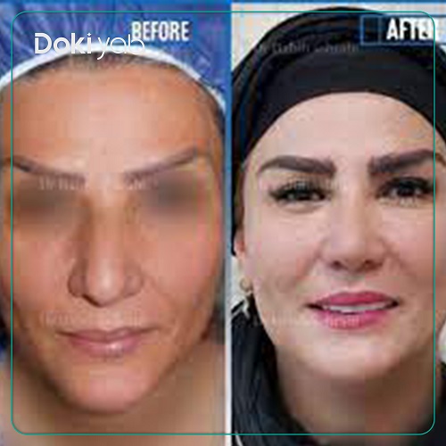 جراحی بینی دکتر حبیب سهرابی