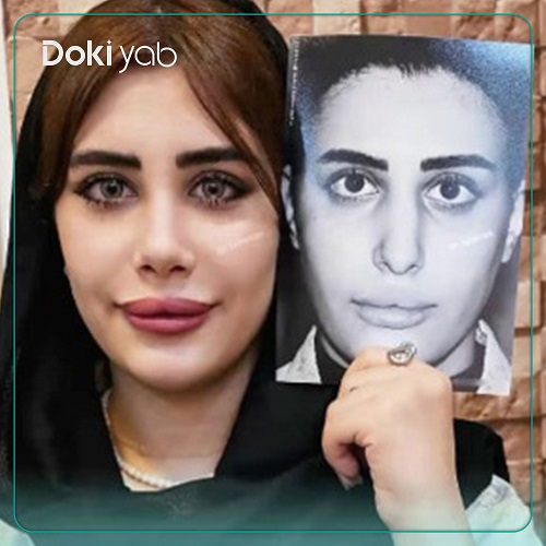 نمونه عمل بینی با دکتر محمدحسین طاهریان جراح بینی در تهران