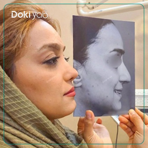 نمونه عمل بینی دکتر محمدحسین طاهریان جراح بینی در تهران