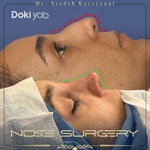 نمونه عمل بینی استخوانی قوزدار با دکتر آزاده کازرونی در اصفهان