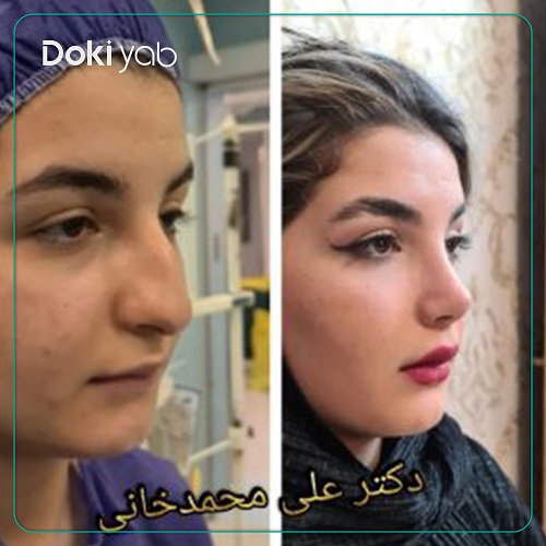 نمونه کار دکتر علی محمدخانی جراح بینی تهران