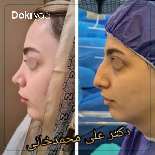 نمونه جراحی بینی دکتر علی محمدخانی جراح بینی در تهران