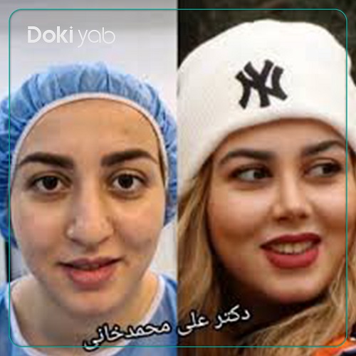 نمونه کار عمل بینی دکتر علی محمدخانی جراح بینی تهران