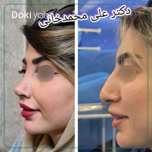 نمونه جراحی بینی دکتر علی محمدخانی جراح بینی در تهران