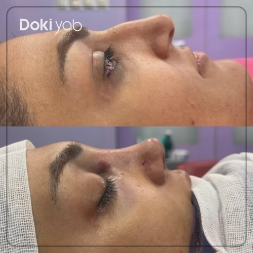 نمونه کار عمل بینی نیمه فانتزی با قوس طبیعی توسط دکتر آزاده کازرونی در اصفهان