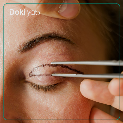 بررسی هزینه بلفاروپلاستی در شیراز در دکی یاب