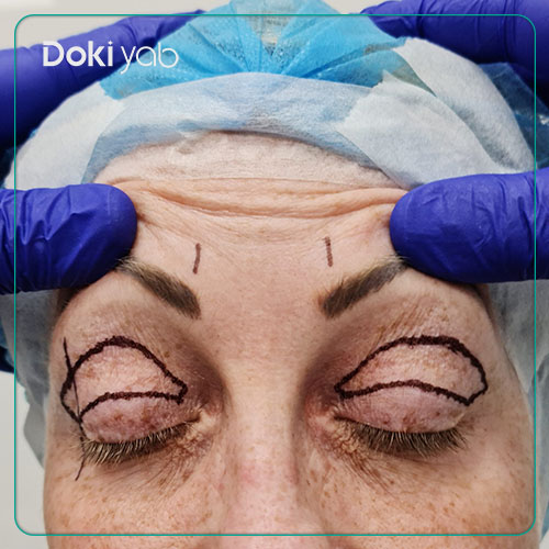 بلفاروپلاستی در شیراز؛ جراحی رفع افتادگی پلک و پف زیر چشم