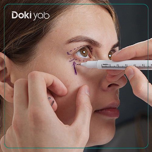 تفاوت بلفاروپلاستی پلک بالا و پایین