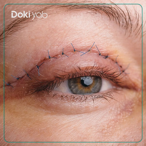 بررسی کاندیدای مناسب بلفاروپلاستی در شیراز