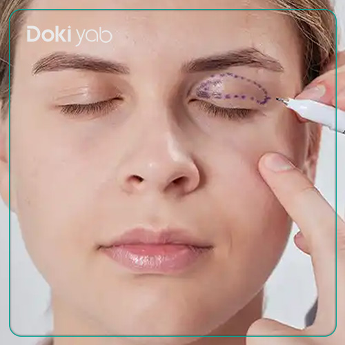 بررسی مشکلاتی که بلفاروپلاستی حل میکند