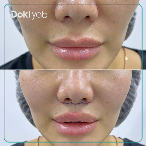 افرادی با فیلتروم بلند؛ کاندیدای مناسب سانترال لب