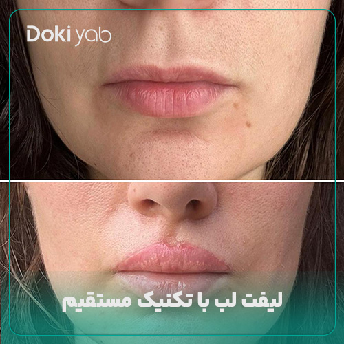 عکس لیفت لب مستقیم؛ دکی یاب