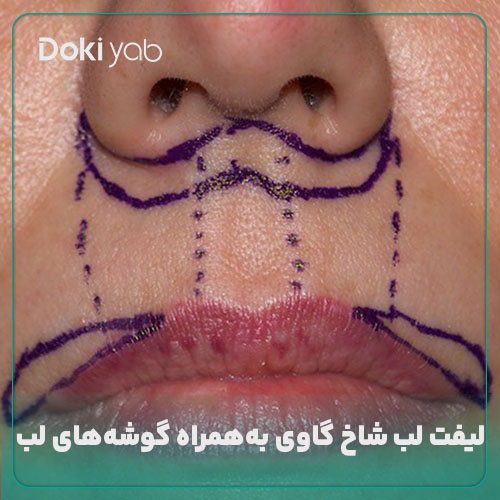عکس لیفت لب شاخ گاوی؛ دکی یاب
