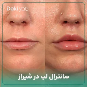 عمل سانترال لب در شیراز
