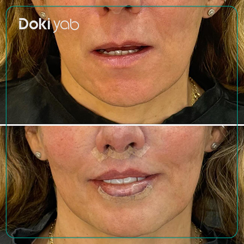 جراحی سانترال لب برای کاهش طول فیلتروم؛ دکی یاب