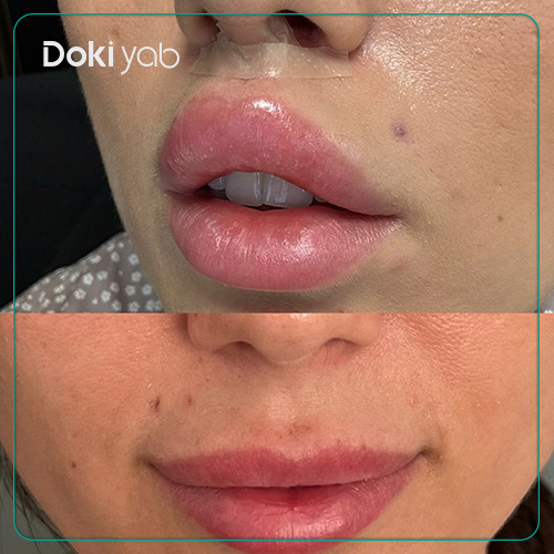 بررسی مزایای لیفت سانترال لب در شیراز در دکی یاب