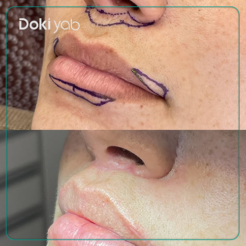 بررسی عوارض جراحی سانترال لب