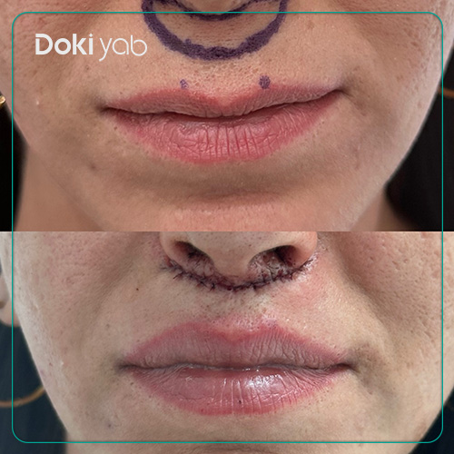 مراقبت‌های قبل از جراحی سانترال لب