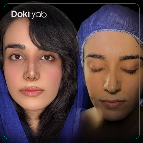 نمونه عمل بینی دکتر محرابی در شیراز