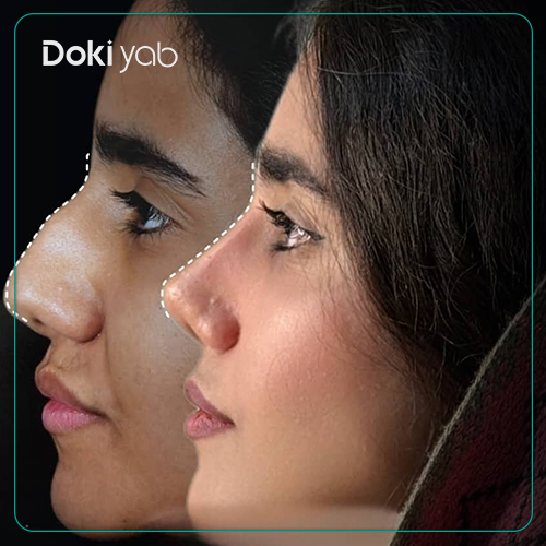 نمونه جراحی بینی دکتر فرهاد محرابی یاسوج