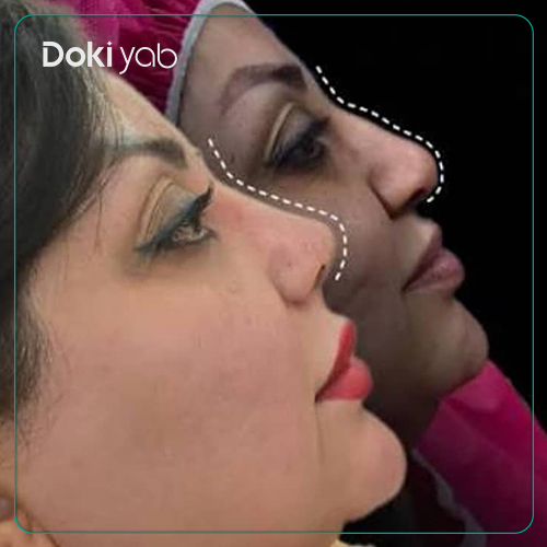 نمونه عمل بینی دکتر فرهاد محرابی سی سخت در شیراز