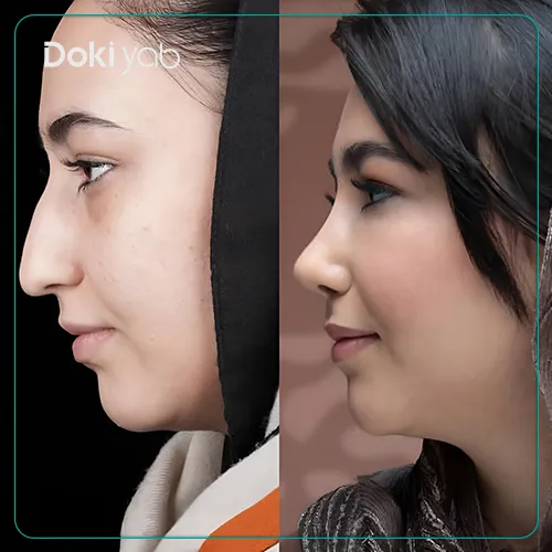 تصویر عمل جراحی بینی با دکتر فرهاد محرابی در شیراز