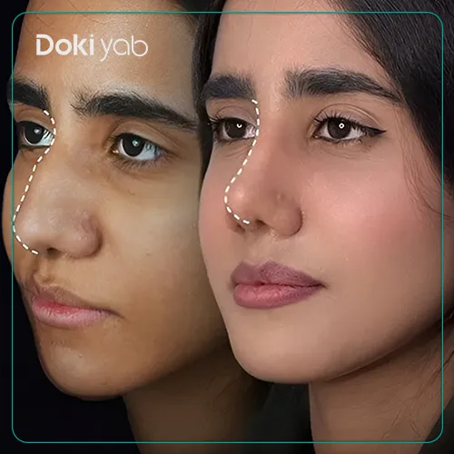 نمونه کار جراحی بینی دکتر فرهاد محرابی در شیراز