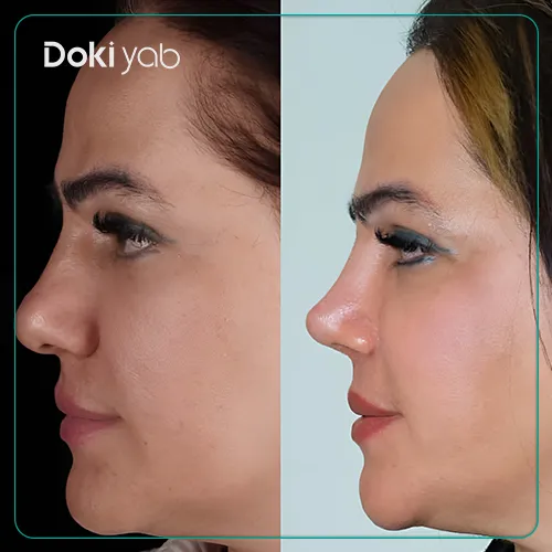 عکس جراحی بینی توسط دکتر محرابی در شیراز