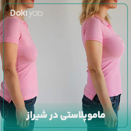 همه چیز درباره ماموپلاستی در شیراز در دکی یاب