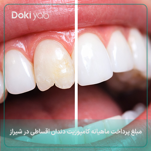 مبلغ پرداخت ماهیانه کامپوزیت دندان اقساطی در شیراز 