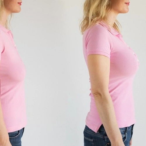 عمل لیفت سینه در شیراز با دکی یاب