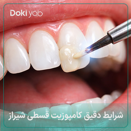 شرایط کامپوزیت قسطی شیراز در دکی یاب