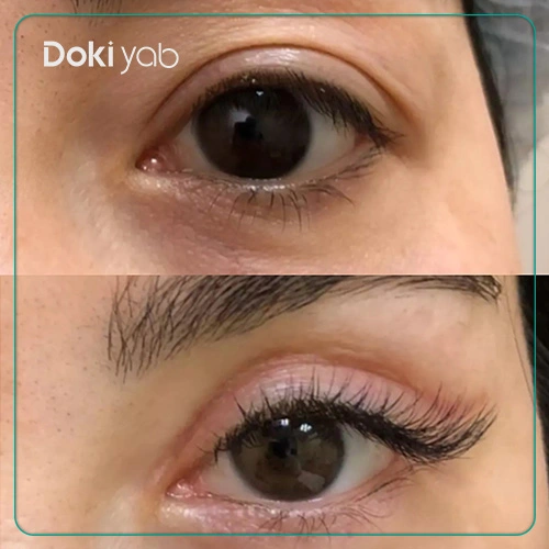 جراحی بلفاروپلاستی توسط دکتر بهزاد علیزاده بهترین جراح پلاستیک شیراز