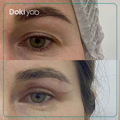 جراحی زیبایی پلک توسط دکتر بهزاد علیزاده بهترین جراح پلاستیک شیراز