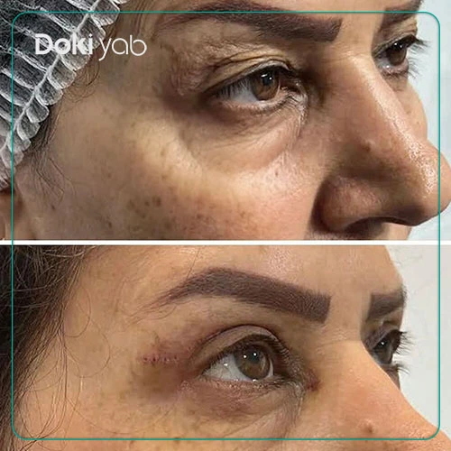 قبل و بعد بلفاروپلاستی توسط دکتر محمد حقیقی فرد جراح پلاستیک شیراز