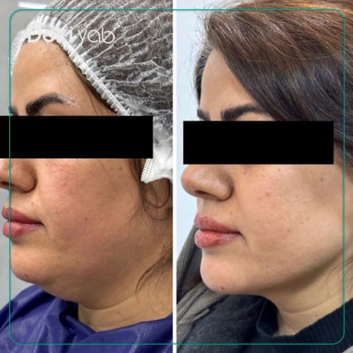 نمونه جراحی غبغب توسط دکتر محمد حقیقی فرد جراح پلاستیک شیراز