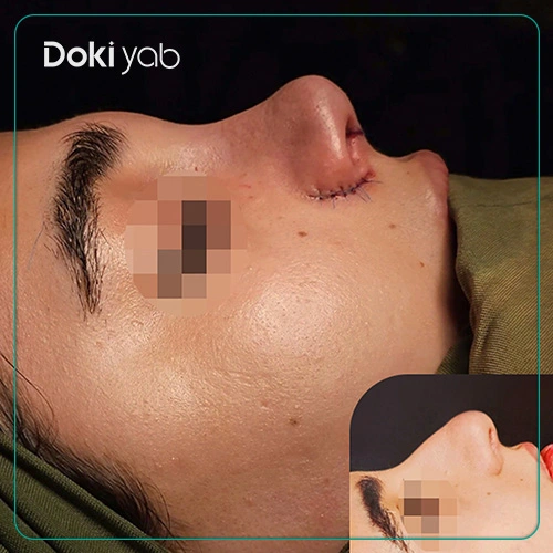 جراحی زیبایی بینی توسط دکتر حامد کبیری جراح پلاستیک شیراز