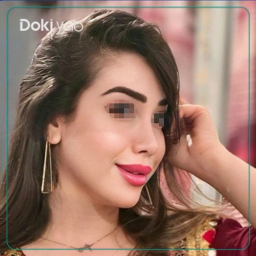 عکس قبل و بعد جراحی بینی توسط دکتر حامد کبیری جراح پلاستیک شیراز