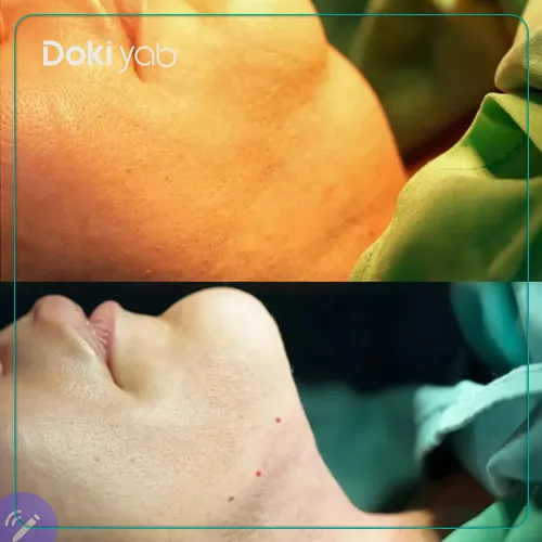 جراحی غبغب توسط دکتر محمد کشاورز یکی از جراحان پلاستیک شیراز