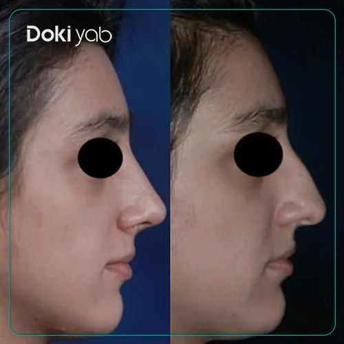 عکس قبل و بعد جراحی بینی توسط دکتر سعید مرزبان جراح پلاستیک در شیراز